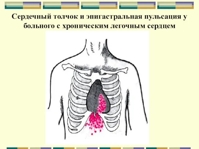 Сердечный толчок и эпигастральная пульсация у больного с хроническим легочным сердцем