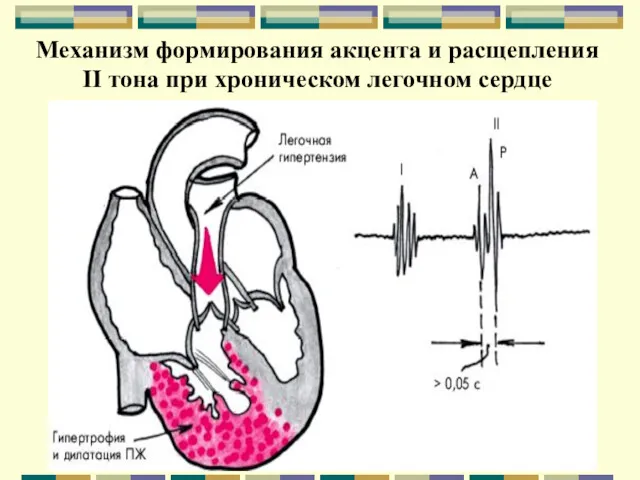 Механизм формирования акцента и расщепления II тона при хроническом легочном сердце