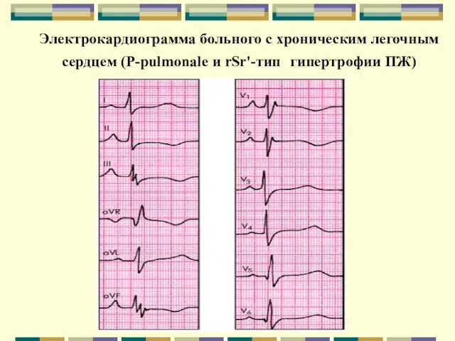 Электрокардиограмма больного с хроническим легочным сердцем (Р-pulmonale и rSr'-тип гипертрофии ПЖ)