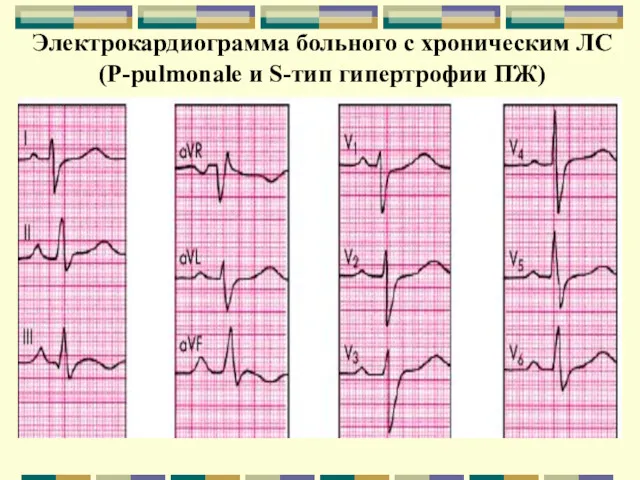 Электрокардиограмма больного с хроническим ЛС (Р-pulmonale и S-тип гипертрофии ПЖ)