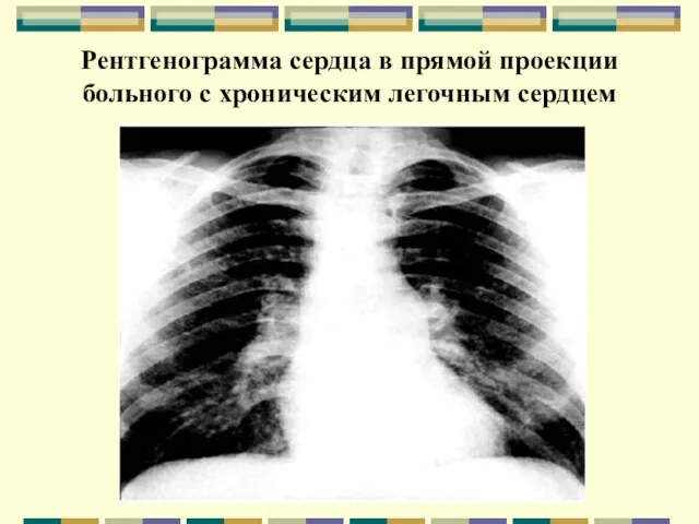 Рентгенограмма сердца в прямой проекции больного с хроническим легочным сердцем