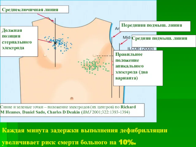 Каждая минута задержки выполнения дефибрилляции увеличивает риск смерти больного на