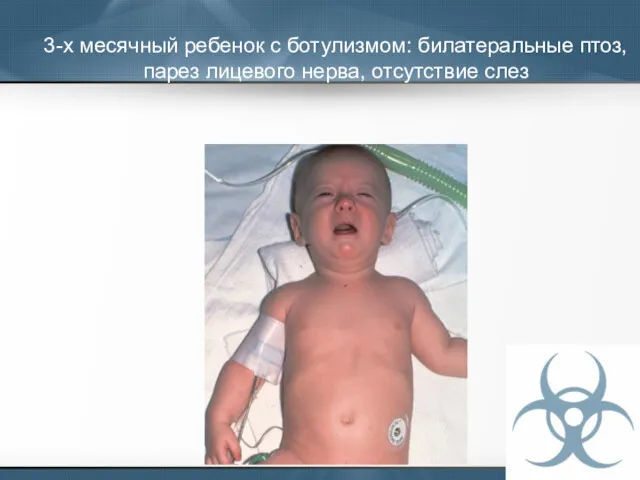 3-х месячный ребенок с ботулизмом: билатеральные птоз, парез лицевого нерва, отсутствие слез