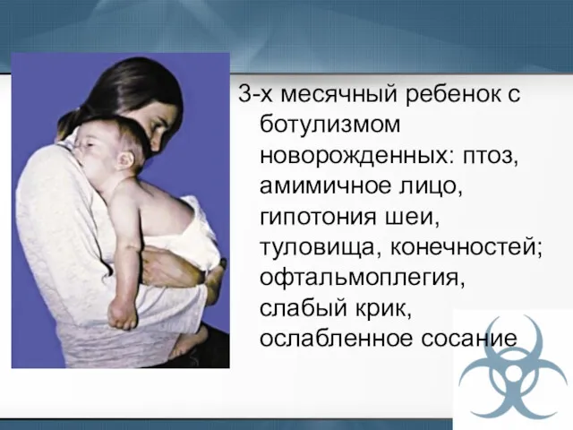 3-х месячный ребенок с ботулизмом новорожденных: птоз, амимичное лицо, гипотония