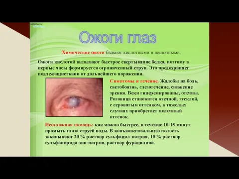 Ожоги глаз Химические ожоги бывают кислотными и щелочными. Симптомы и течение. Жалобы на