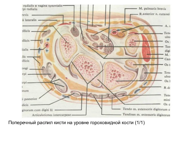 Поперечный распил кисти на уровне гороховидной кости (1/1)