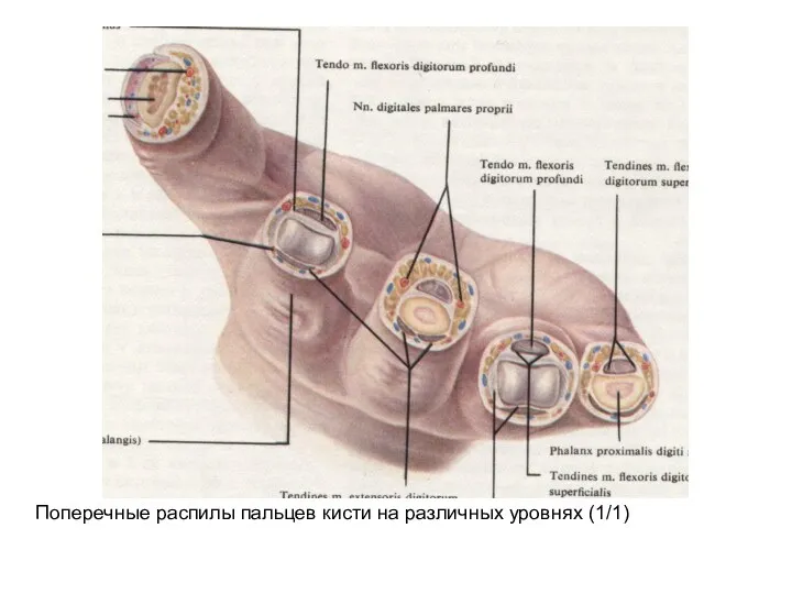 Поперечные распилы пальцев кисти на различных уровнях (1/1)