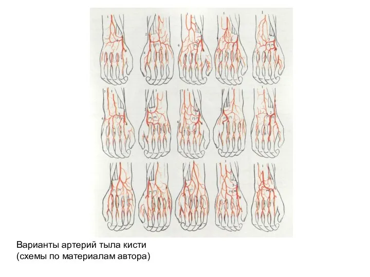 Варианты артерий тыла кисти (схемы по материалам автора)