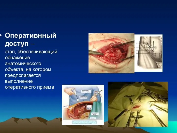 Оперативнный доступ – этап, обеспечивающий обнажение анатомического объекта, на котором предполагается выполнение оперативного приема