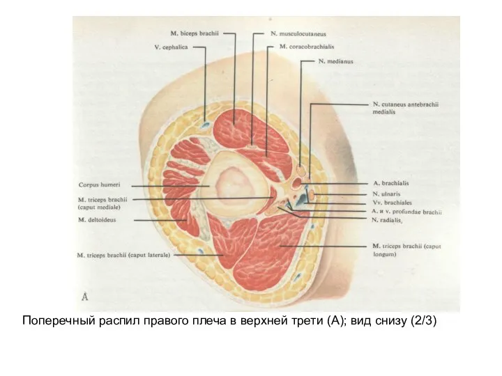 Поперечный распил правого плеча в верхней трети (А); вид снизу (2/3)