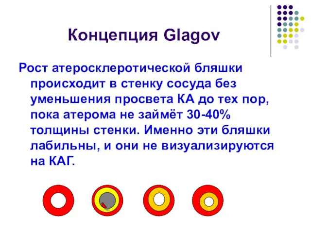 Концепция Glagov Рост атеросклеротической бляшки происходит в стенку сосуда без