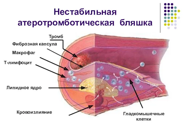 Нестабильная атеротромботическая бляшка Тромб Фиброзная капсула Макрофаг Т-лимфоцит Липидное ядро Кровоизлияние Гладкомышечные клетки