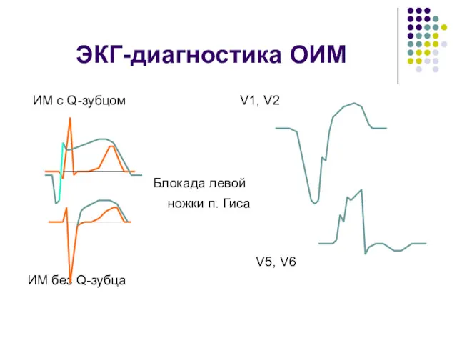 ЭКГ-диагностика ОИМ ИМ с Q-зубцом V1, V2 Блокада левой ножки