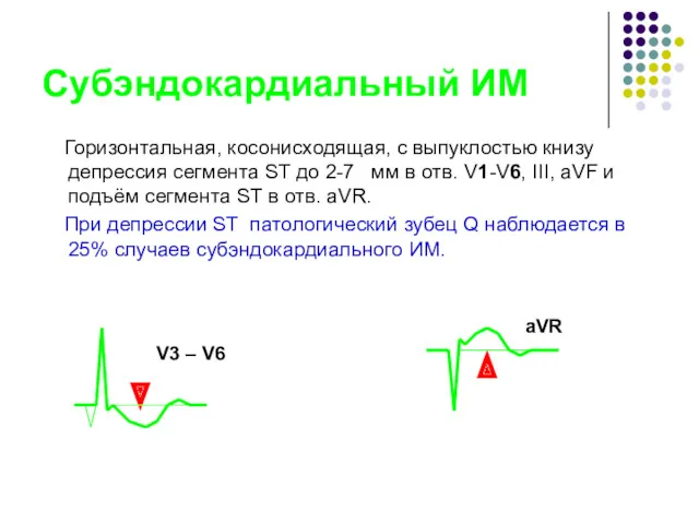 Субэндокардиальный ИМ Горизонтальная, косонисходящая, с выпуклостью книзу депрессия сегмента ST
