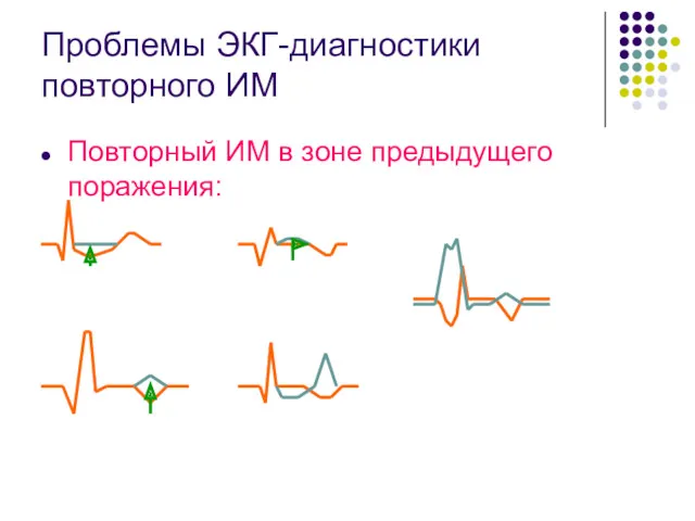 Проблемы ЭКГ-диагностики повторного ИМ Повторный ИМ в зоне предыдущего поражения: