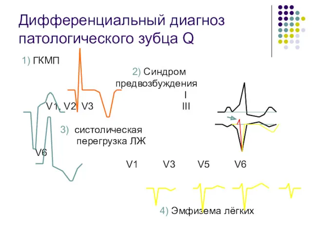 Дифференциальный диагноз патологического зубца Q 1) ГКМП 2) Синдром предвозбуждения