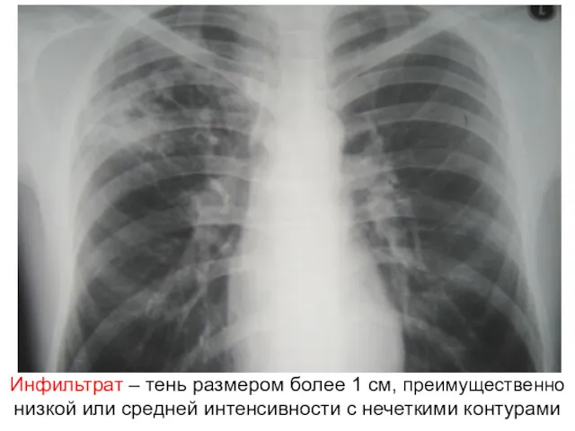 Инфильтрат – тень размером более 1 см, преимущественно низкой или средней интенсивности с нечеткими контурами