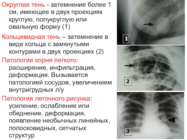 Округлая тень - затемнение более 1 см, имеющее в двух