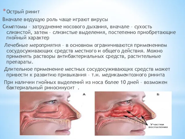 Острый ринит Вначале ведущую роль чаще играют вирусы Симптомы – затруднение носового дыхания,