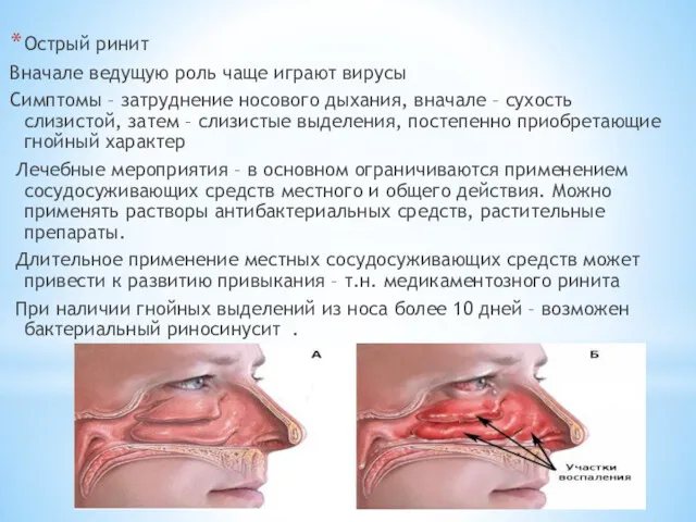 Острый ринит Вначале ведущую роль чаще играют вирусы Симптомы –