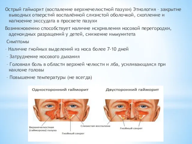 Острый гайморит (воспаление верхнечелюстной пазухи) Этиология – закрытие выводных отверстий воспалённой слизистой оболочкой,