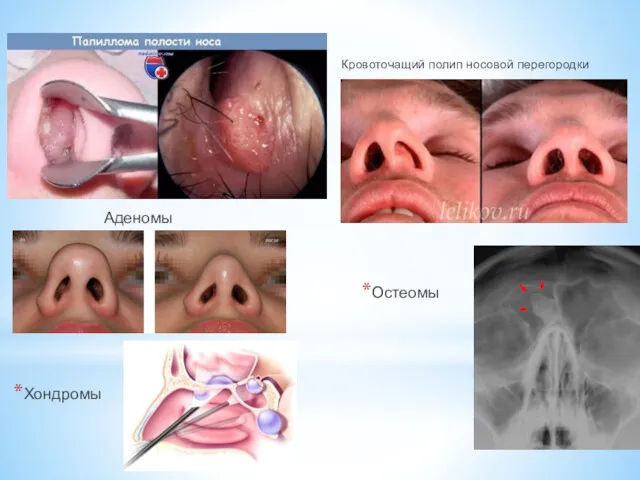 Кровоточащий полип носовой перегородки Аденомы Хондромы Остеомы