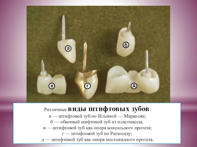 Различные виды штифтовых зубов: а — штифтовой зуб по Ильиной