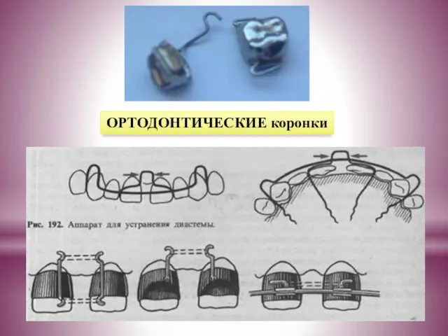 ОРТОДОНТИЧЕСКИЕ коронки