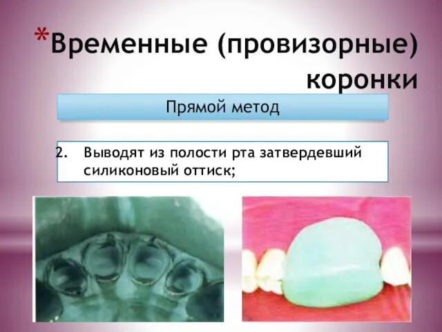 Временные (провизорные) коронки Прямой метод Выводят из полости рта затвердевший силиконовый оттиск;