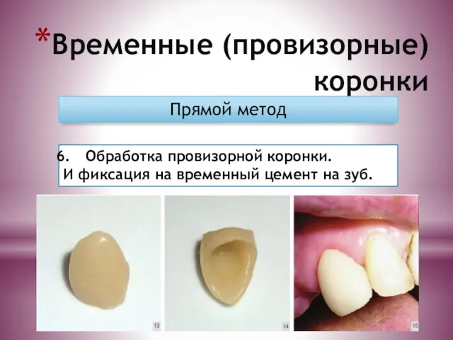 Временные (провизорные) коронки Прямой метод Обработка провизорной коронки. И фиксация на временный цемент на зуб.