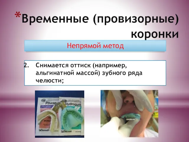 Временные (провизорные) коронки Непрямой метод Снимается оттиск (например, альгинатной массой) зубного ряда челюсти;