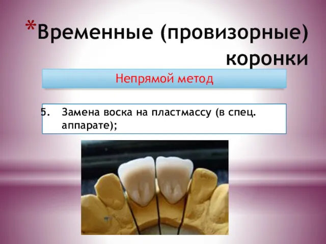 Временные (провизорные) коронки Непрямой метод Замена воска на пластмассу (в спец.аппарате);