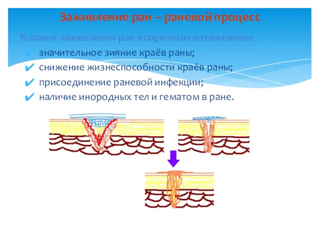 Условия заживления ран вторичным натяжением: значительное зияние краёв раны; снижение