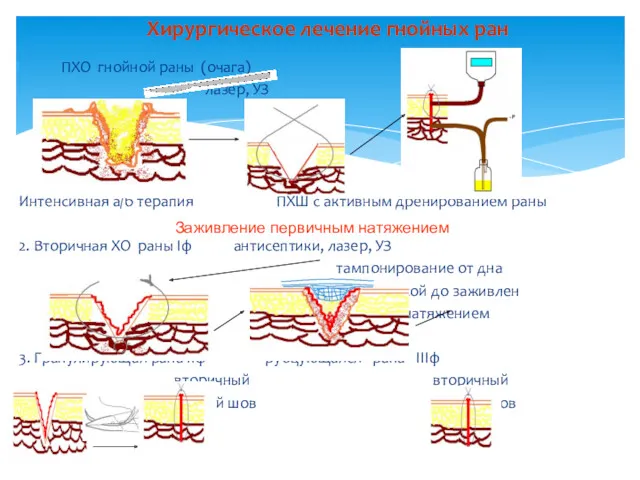 ПХО гнойной раны (очага) лазер, УЗ Интенсивная а/б терапия ПХШ