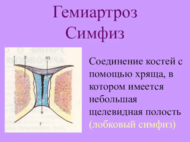 Гемиартроз Симфиз Соединение костей с помощью хряща, в котором имеется небольшая щелевидная полость (лобковый симфиз)