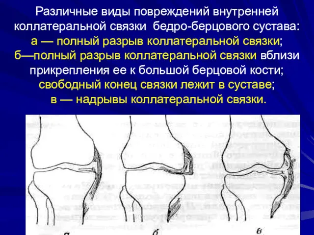 Различные виды повреждений внутренней коллатеральной связки бедро-берцового сустава: а —