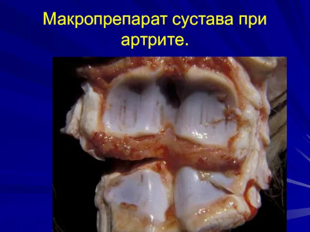 Макропрепарат сустава при артрите.