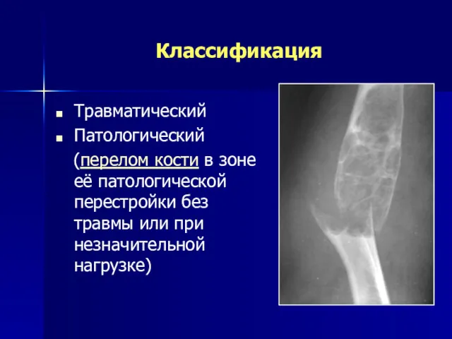 Классификация Травматический Патологический (перелом кости в зоне её патологической перестройки без травмы или при незначительной нагрузке)