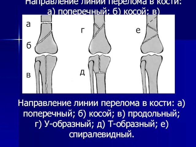 Направление линии перелома в кости: а) поперечный; б) косой; в)