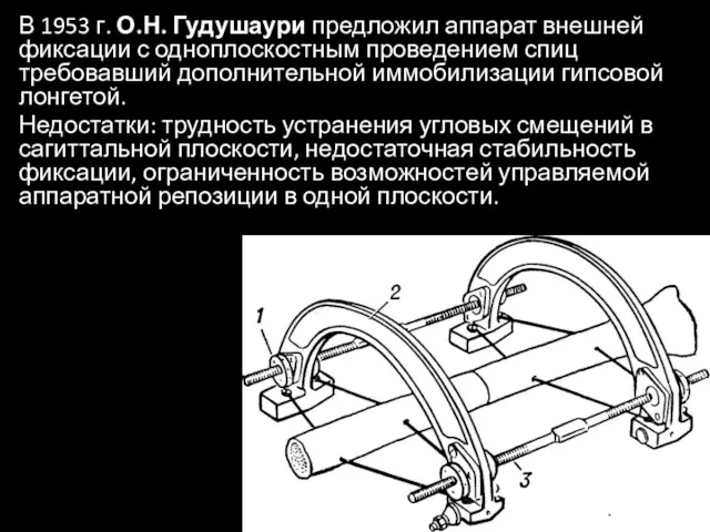 В 1953 г. О.Н. Гудушаури предложил аппарат внешней фиксации с одноплоскостным проведением спиц