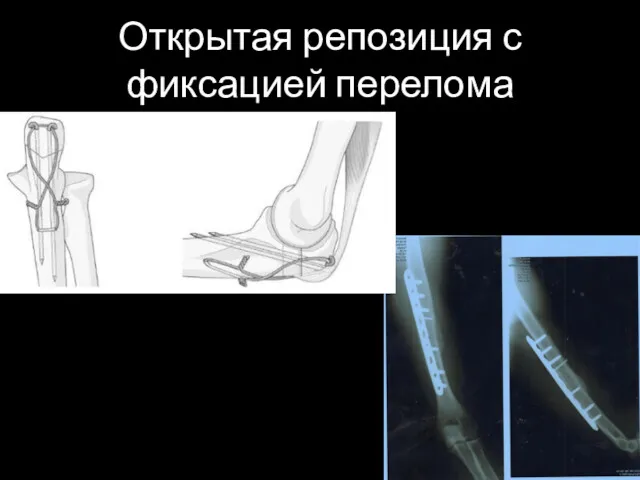 Открытая репозиция с фиксацией перелома