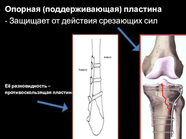 Опорная (поддерживающая) пластина - Защищает от действия срезающих сил Её разновидность – противоскользящая пластина