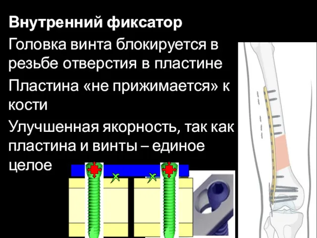 Внутренний фиксатор Головка винта блокируется в резьбе отверстия в пластине