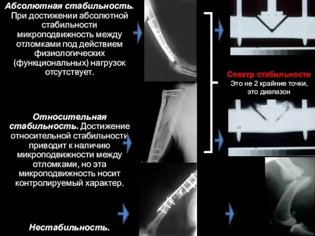 Абсолютная стабильность. При достижении абсолютной стабильности микроподвижность между отломками под