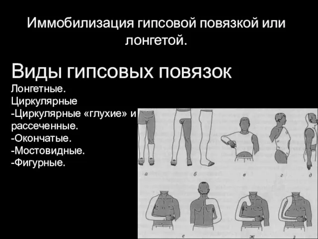 Иммобилизация гипсовой повязкой или лонгетой. Виды гипсовых повязок Лонгетные. Циркулярные