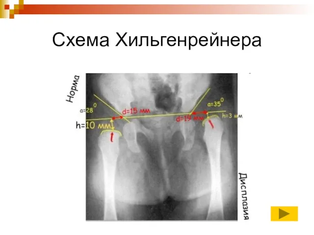 Схема Хильгенрейнера