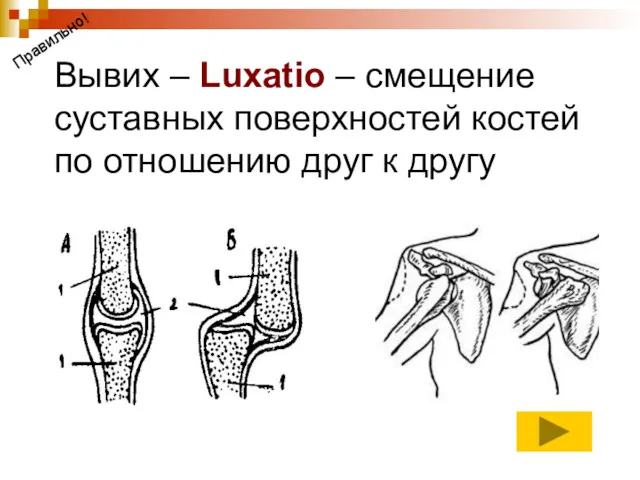 Вывих – Luxatio – смещение суставных поверхностей костей по отношению друг к другу Правильно!