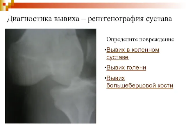 Диагностика вывиха – рентгенография сустава Определите повреждение Вывих в коленном суставе Вывих голени Вывих большеберцовой кости