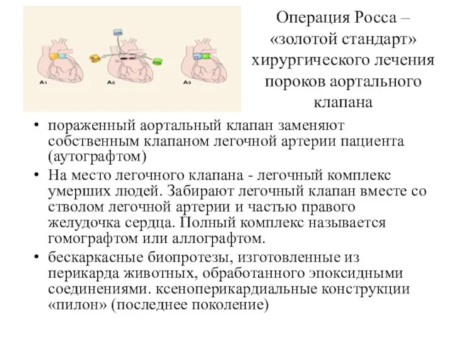 Операция Росса – «золотой стандарт» хирургического лечения пороков аортального клапана