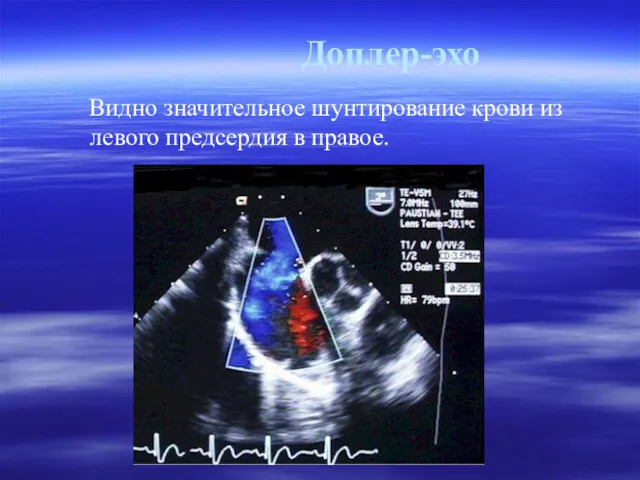Доплер-эхо Видно значительное шунтирование крови из левого предсердия в правое.